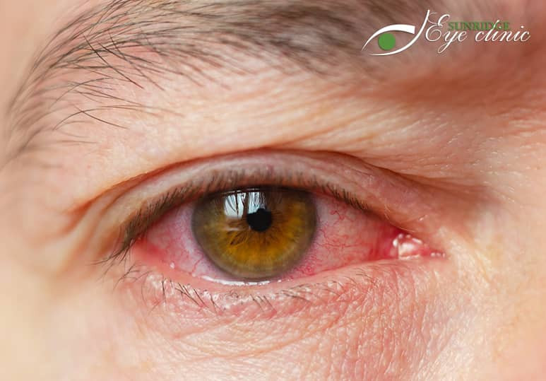 Sunridge Eye clinic - Blog - Eye Inflammation