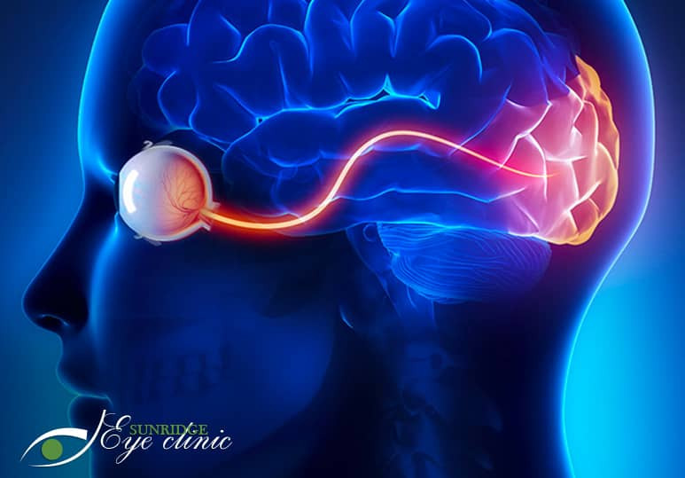 Sunridge Eye clinic - Blog - Cerebral Visual Impairment And How Can An Eye Doctor Help