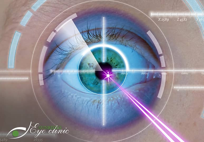 Sunridge Eye clinic - Blog - What Role Does Your Optometrist Play In Laser Eye Surgery