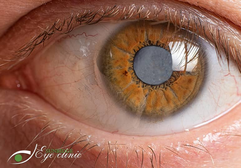 Sunridge Eye clinic - Blog - How Can I Tell If I May Need Cataract Surgery