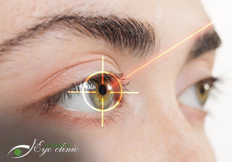 What Happens During Laser Eye Surgery | Optometrist Calgary