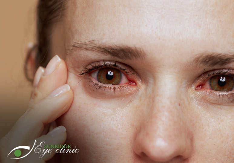 Calgary Eye Emergencies: What to Do When Vision Changes Suddenly