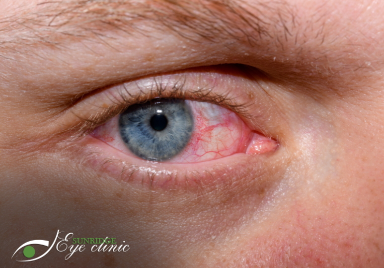 Dry Eye Treatment Options: Relief for Calgary Patients 