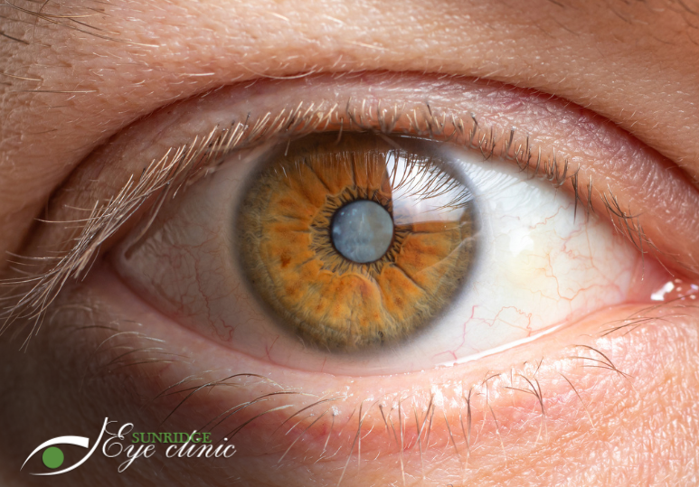 Cataract Management: When Is It Time for Surgery? 