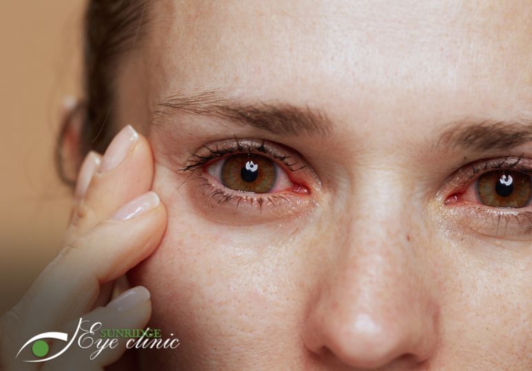 Dry Eye Care 101: The Ultimate Guide to Soothing Your Eyes Naturally