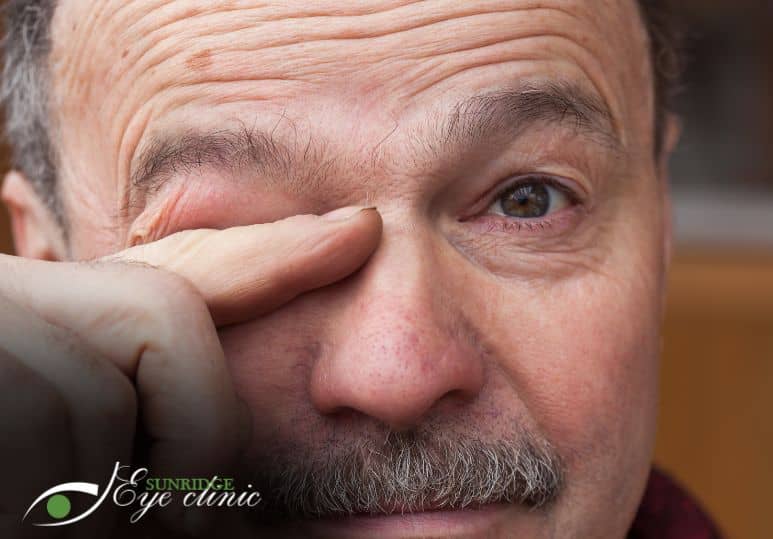 3 Myths About Cataracts